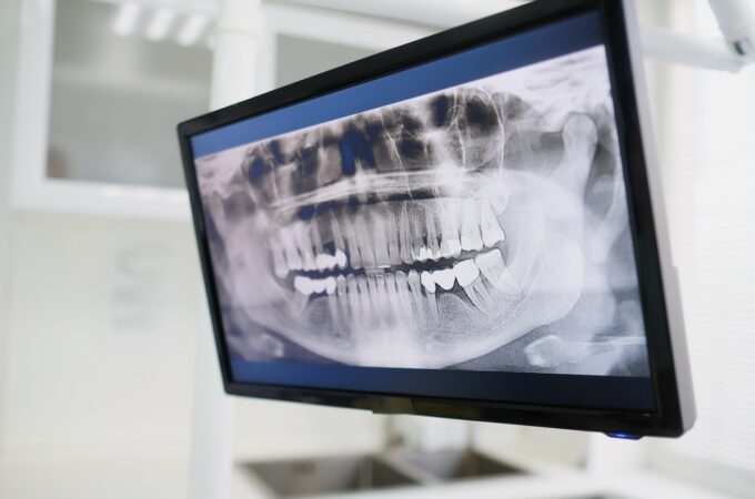 Kiedy należy wykonać RTG zębów?